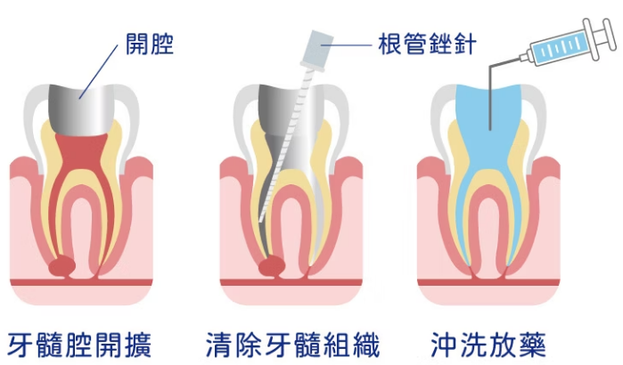 深圳睇牙邊度好？杜牙根要幾耐才能完成？