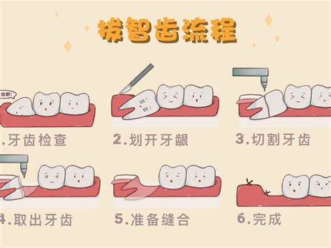 深圳拔智齿流程