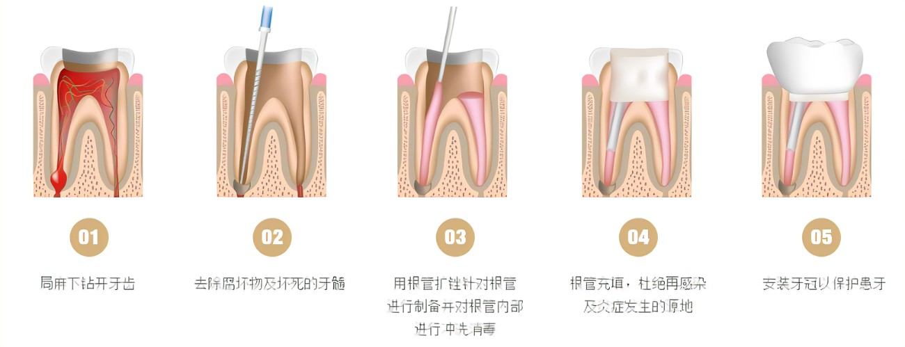 根管治疗的步骤