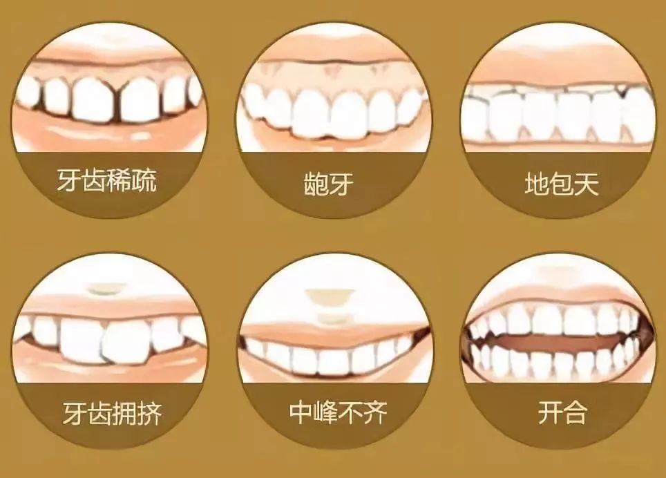 牙齿深覆盖深圳牙科
