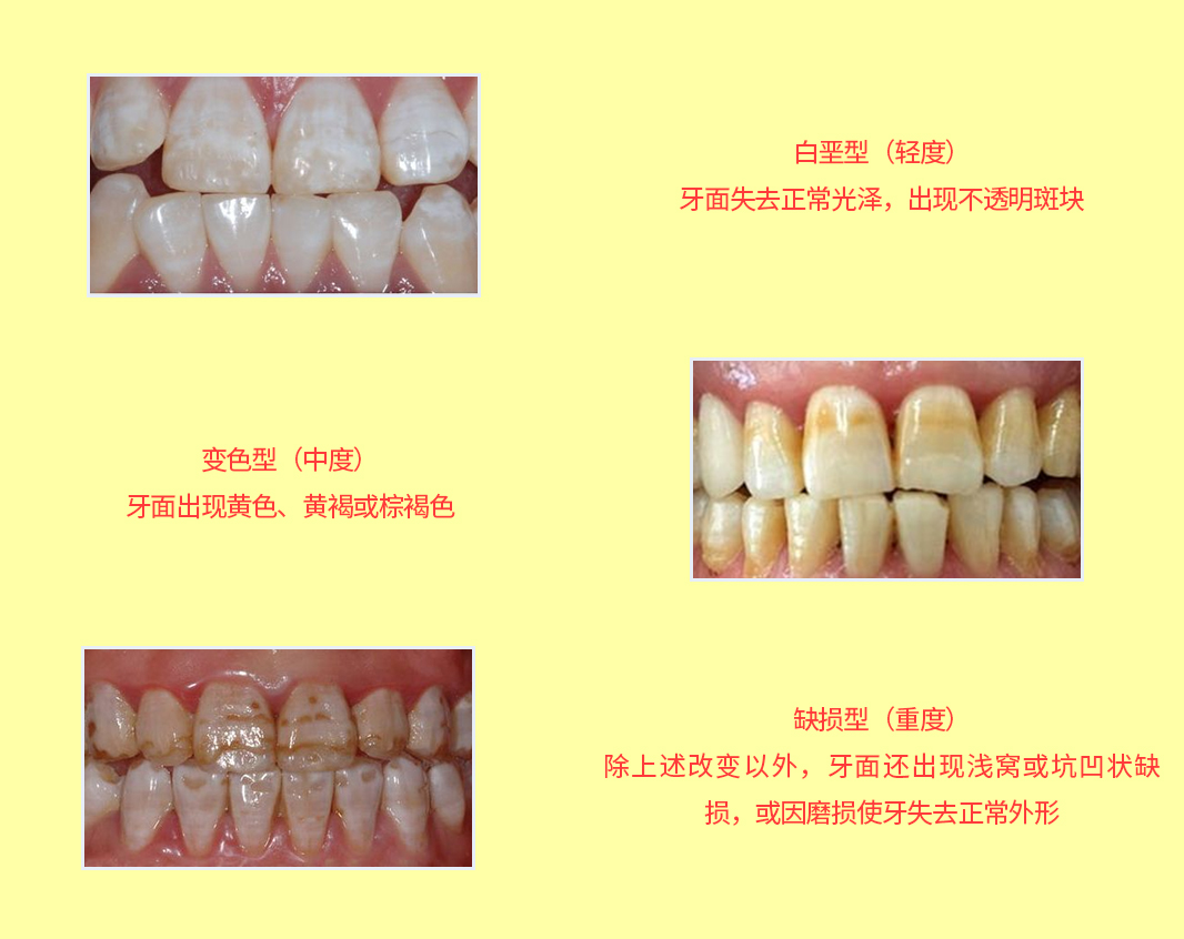 氟斑牙是什么？深圳維港口腔
