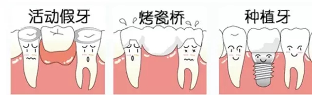 镶牙究竟该怎么选择