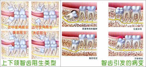 深圳維港口腔拔智齒
