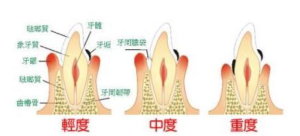 深圳治療牙周病的