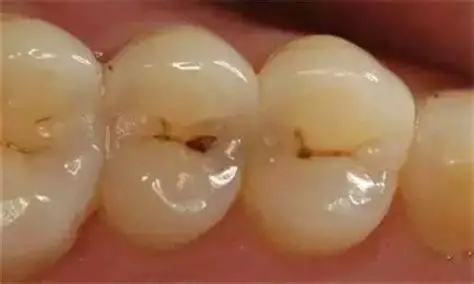 牙齒上的小黑點