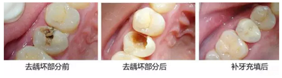 深圳補牙