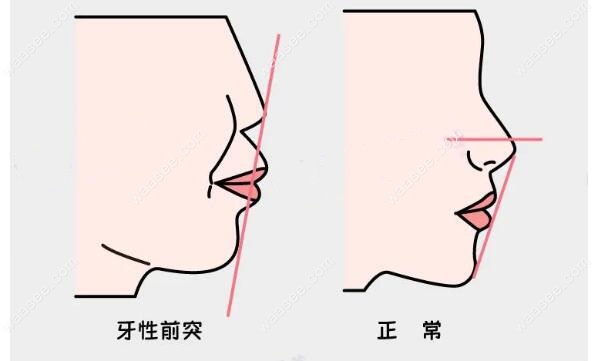 嘴凸點算