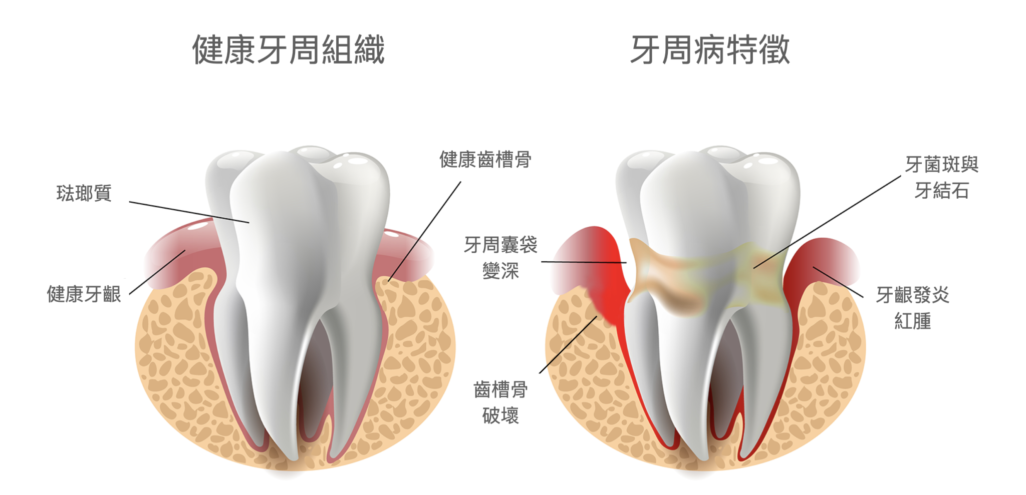 牙周病是什麼？