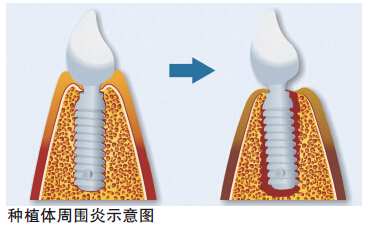 種植體周圍炎如何預防