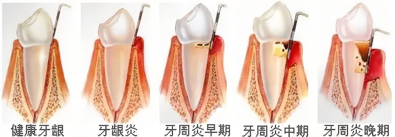 牙周治療