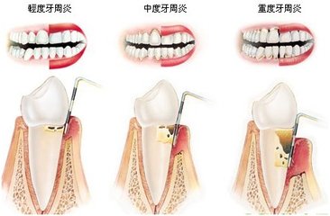 牙周炎治療-維港口腔