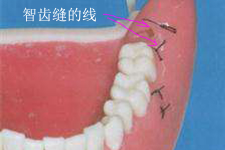 拔智齒複診拆線