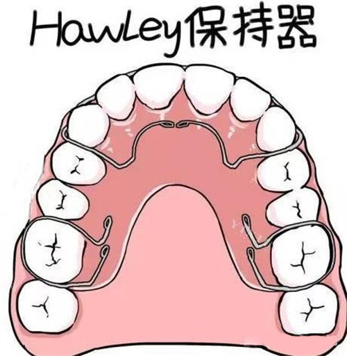 深圳做保持器幾錢？哈雷保持器和透明保持器有乜區別？