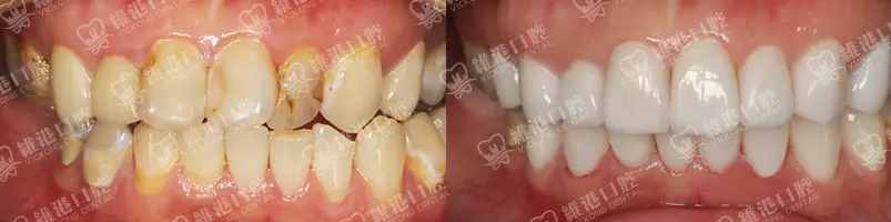 深圳種牙&深圳維港口腔