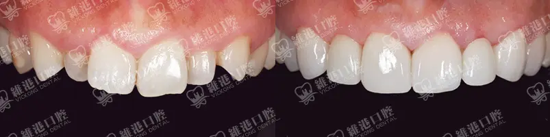 深圳種牙&深圳維港口腔