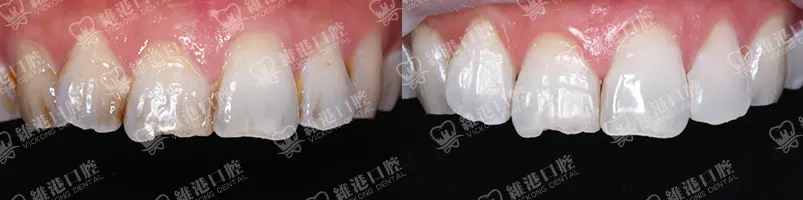 深圳種牙&深圳維港口腔