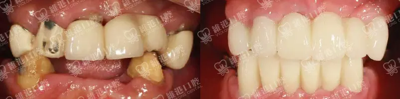 深圳種牙&深圳維港口腔