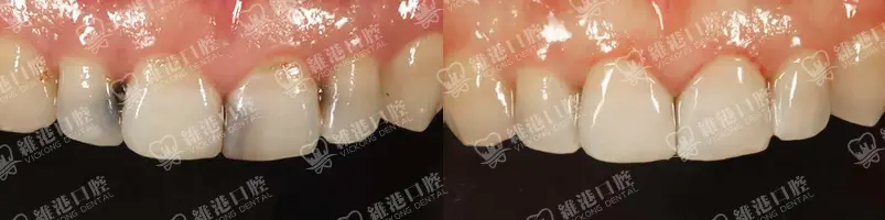 深圳種牙&深圳維港口腔