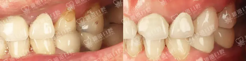 深圳種牙&深圳維港口腔