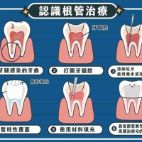深圳杜牙根價錢？後牙杜牙根點解咁貴？