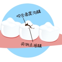 深圳牙醫科普：單側咀噍會有咩危害？ 