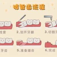深圳拔智齒後牙齦麻木的原因與應對方法
