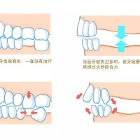 深圳種牙：長期牙齒缺失有咩危害？