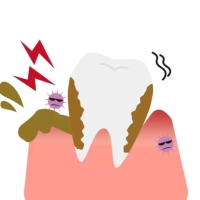 牙周病如何治療？北上睇牙邊間好？