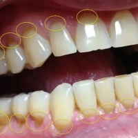 牙根出現楔缺可以通過補牙來修復嗎？深圳補牙幾錢？