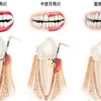 深圳牙周病收費？如何自測輕中重度牙周病？