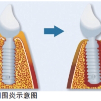深圳種牙後如何預防牙周圍炎？