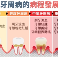 深圳牙周治療價錢？牙周病治療好後會復發嗎？
