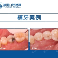 深圳福田口岸邊間牙科補牙好？深圳牙科補牙幾錢？