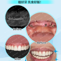 缺牙後選擇種牙還是鑲牙？深圳種牙幾錢？