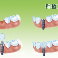 深圳種牙前需留意！這些情況暫時或永久不適合