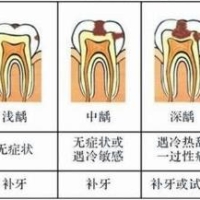 點解深齲補牙墊底易失敗？維港口腔來揭秘