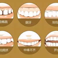 深圳箍牙點解有些人要拔牙？