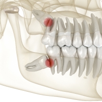 深圳拔智齿價錢？为什么智齿容易发炎？