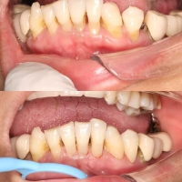 牙齦萎縮怎麼辦？深圳睇牙邊間好？