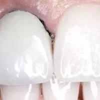 金屬牙套和全瓷牙套哪種牙套比較好？深圳哪家牙科做牙套比較好?