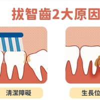 深圳拔智齿價錢？每个人都会长智齿吗？