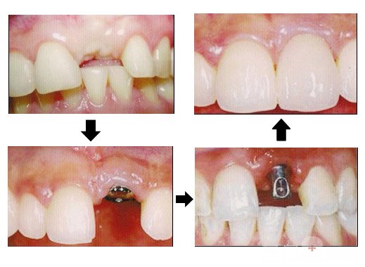 拔牙後能不能立即種植牙？