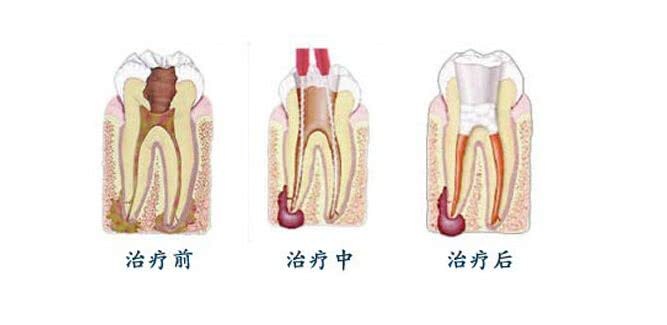 什麼是根管治療？