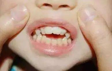 剛萌出的門牙為什麼顯得特別大？
