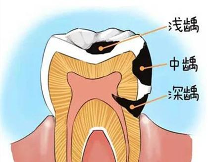 怎樣判斷患有齲齒？