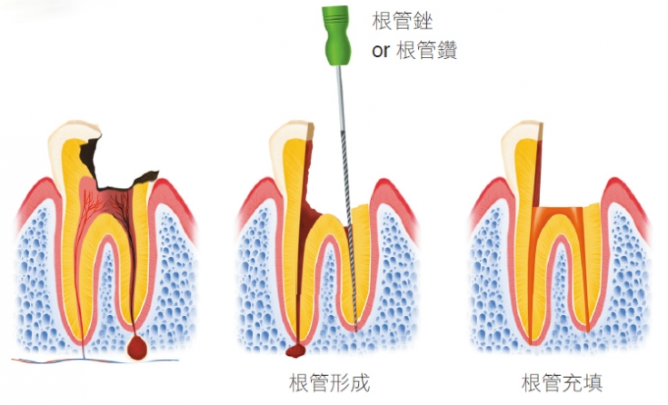 根管治療的步驟有哪些？