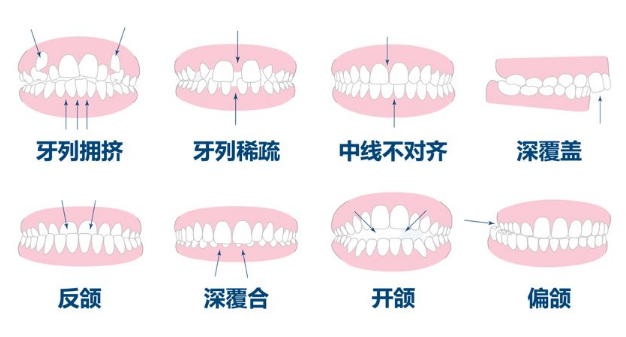 箍牙類型