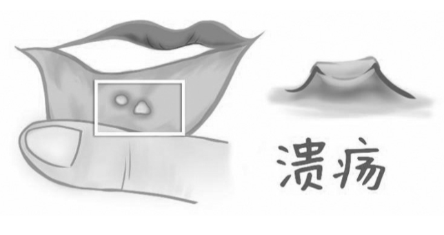 在深圳有什麼方法可以減少口腔潰瘍呢？