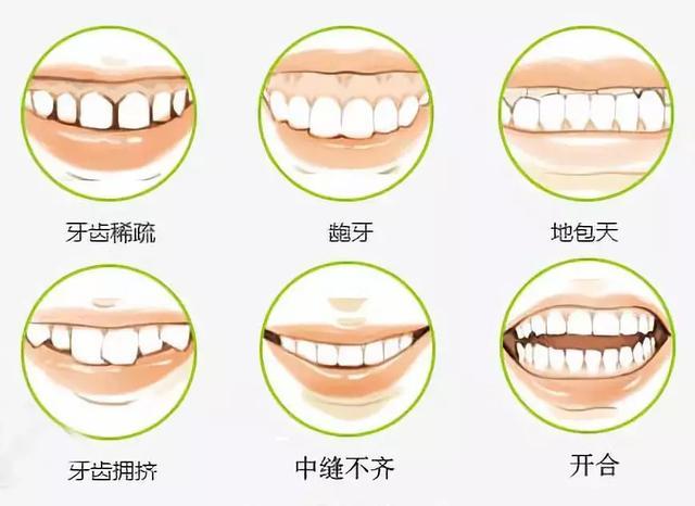 深圳做牙齒矯正有哪些牙套類型可以選擇？