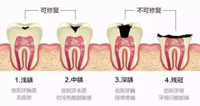 深圳牙科-發現自己牙齒裂縫是怎麼回事？